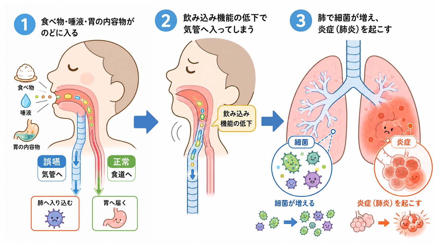 誤嚥性肺炎とは(疾患概要・病態メカニズム)
