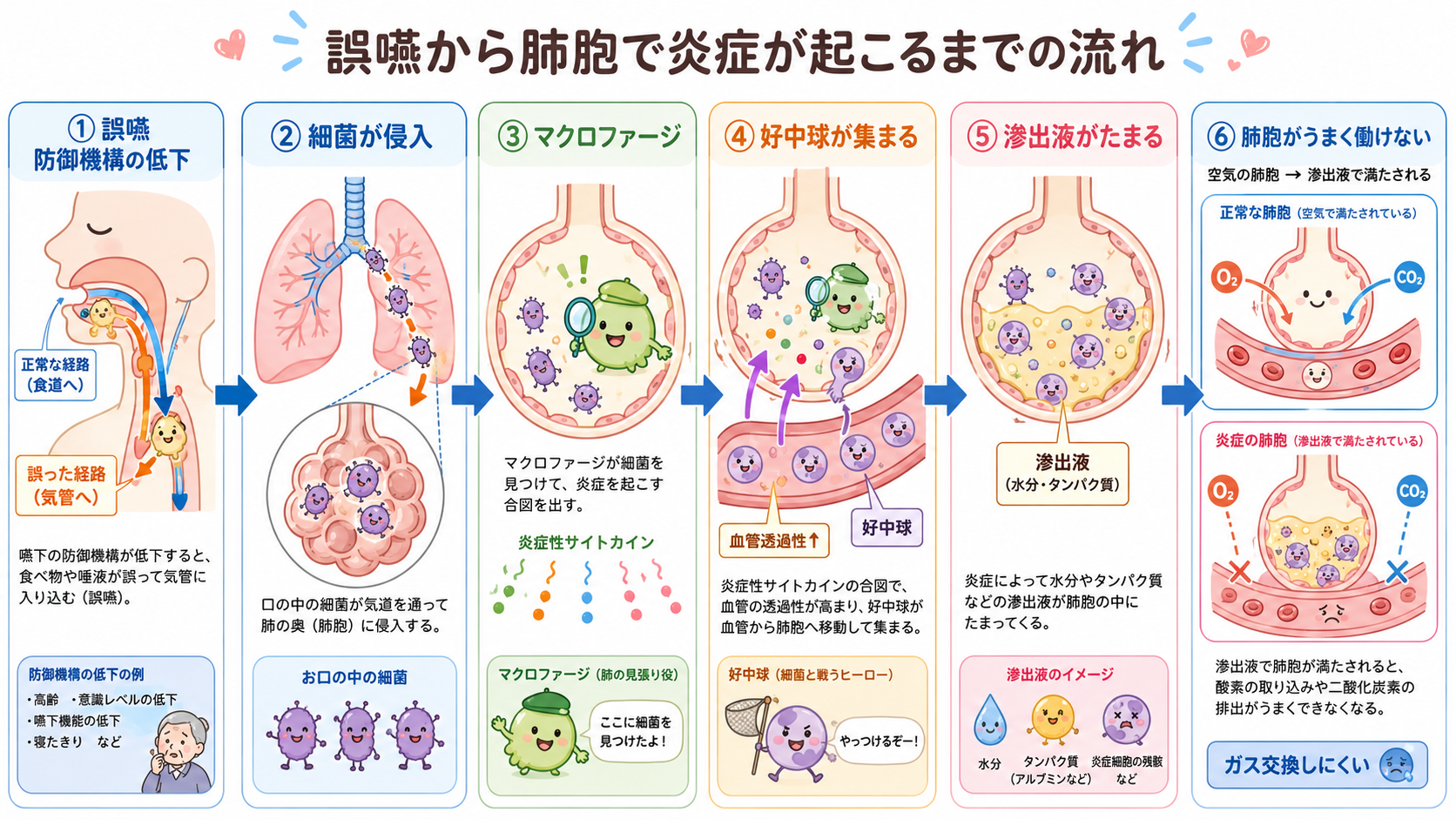 誤嚥から肺胞で炎症が起こるまでの流れ
