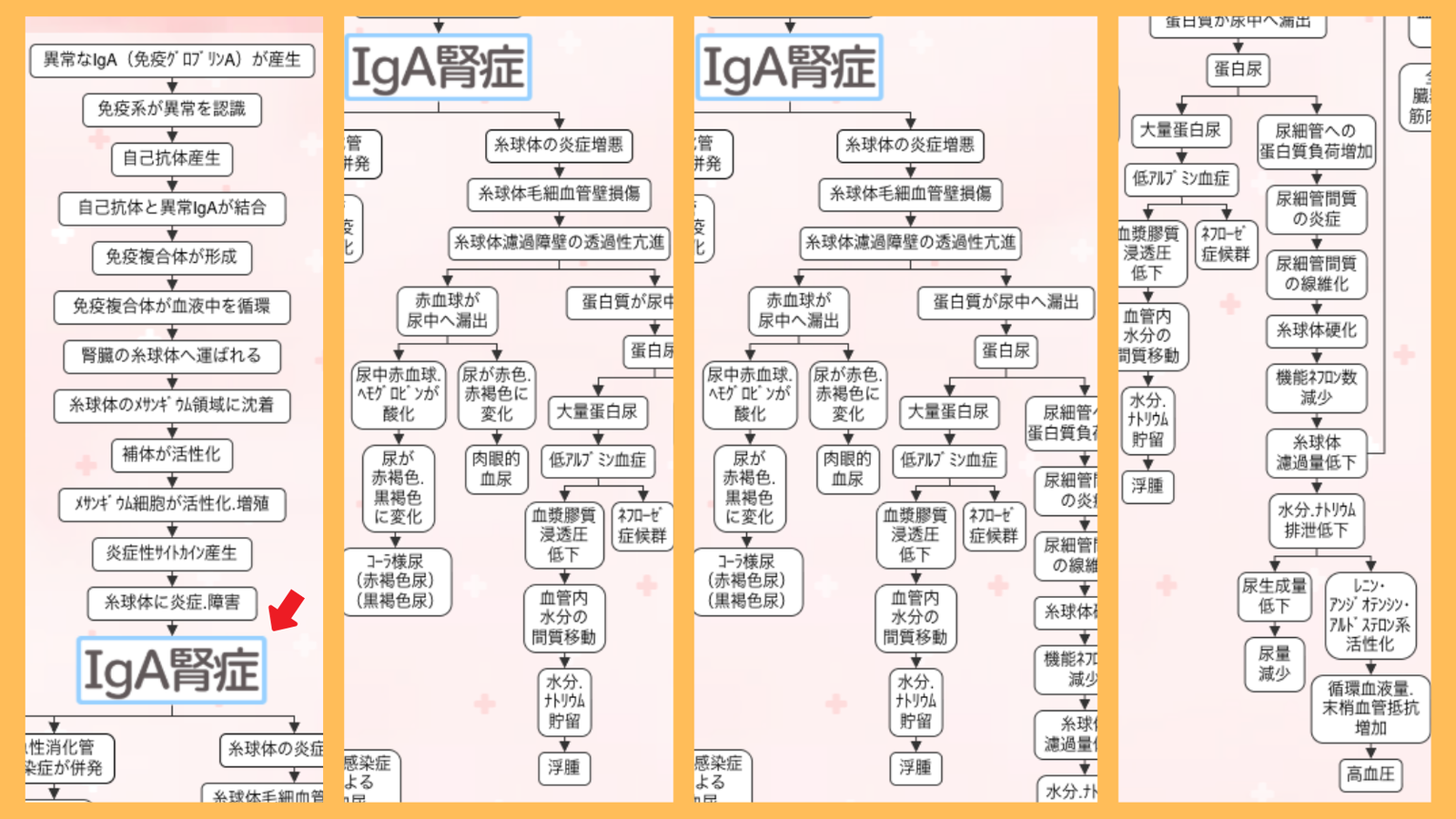 IgA腎症の原因の関連図。異常なIgAの産生から自己抗体・免疫複合体の形成、メサンギウム領域への沈着、糸球体の炎症までの流れ