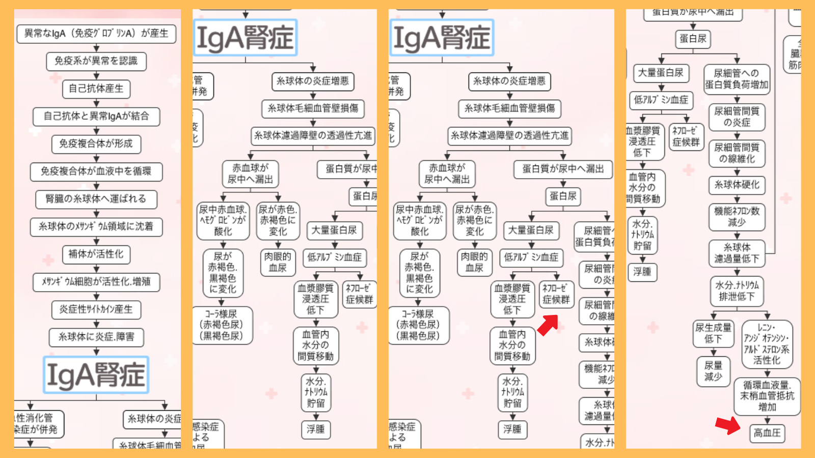 IgA腎症の合併症の関連図。蛋白尿からネフローゼ症候群に至る流れと、尿細管間質の線維化から高血圧に至る流れ