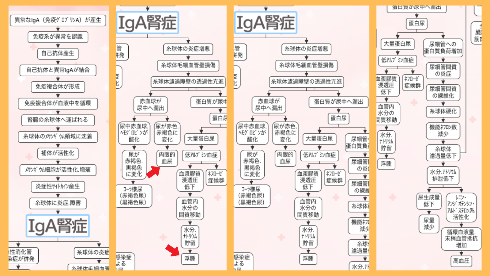 IgA腎症の症状の関連図。糸球体濾過障壁の透過性亢進から肉眼的血尿と浮腫に至る流れ