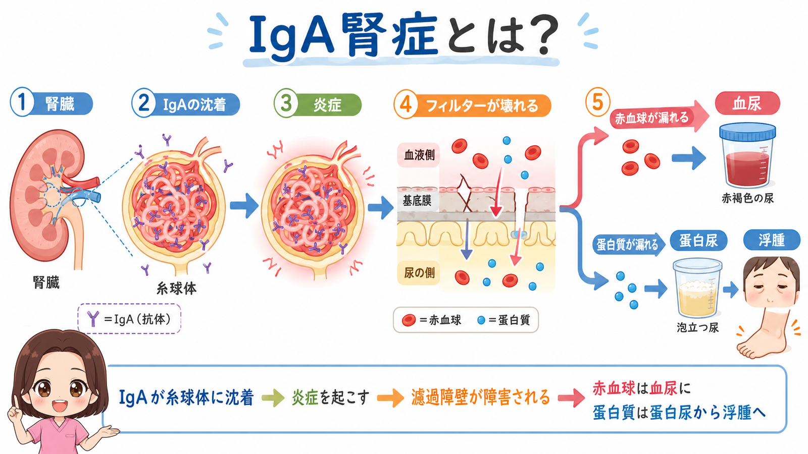 IgA腎症とは？IgAが糸球体に沈着して炎症を起こし、赤血球が漏れて血尿に、蛋白質が漏れて蛋白尿・浮腫になる流れの図解