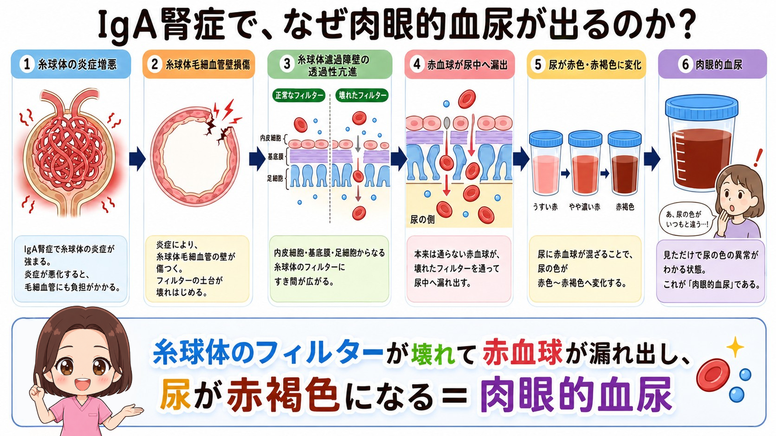 IgA腎症で肉眼的血尿が出るしくみの図解。糸球体の炎症増悪から毛細血管壁の損傷、濾過障壁の透過性亢進、赤血球の漏出を経て尿が赤褐色になるまでの6ステップ