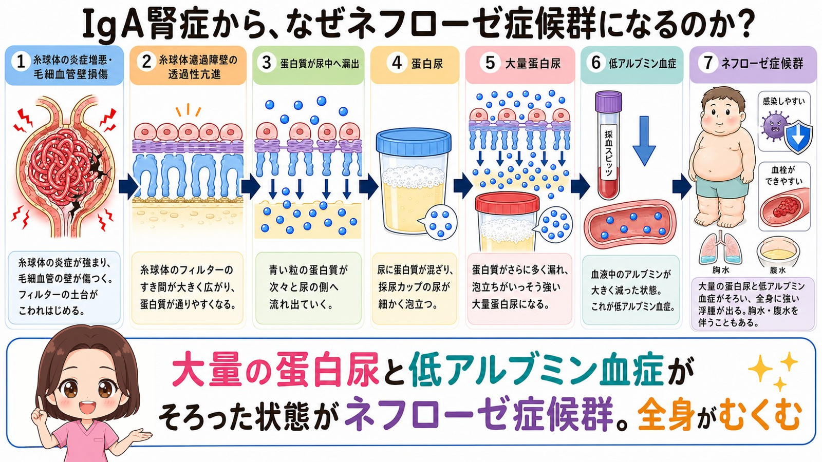 IgA腎症からネフローゼ症候群になるしくみの図解。蛋白尿から大量蛋白尿、低アルブミン血症を経て全身の高度な浮腫に至るまでの7ステップ