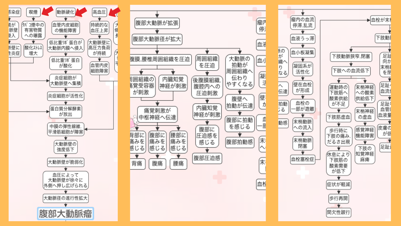腹部大動脈瘤の原因の関連図。喫煙・動脈硬化・高血圧などの入口から、炎症細胞が大動脈壁へ集積し蛋白質分解酵素が放出され、中膜の弾性線維・平滑筋細胞が障害されて大動脈壁が脆弱化し、血圧に押し広げられて腹部大動脈瘤に至るまでを矢印でつないだ図