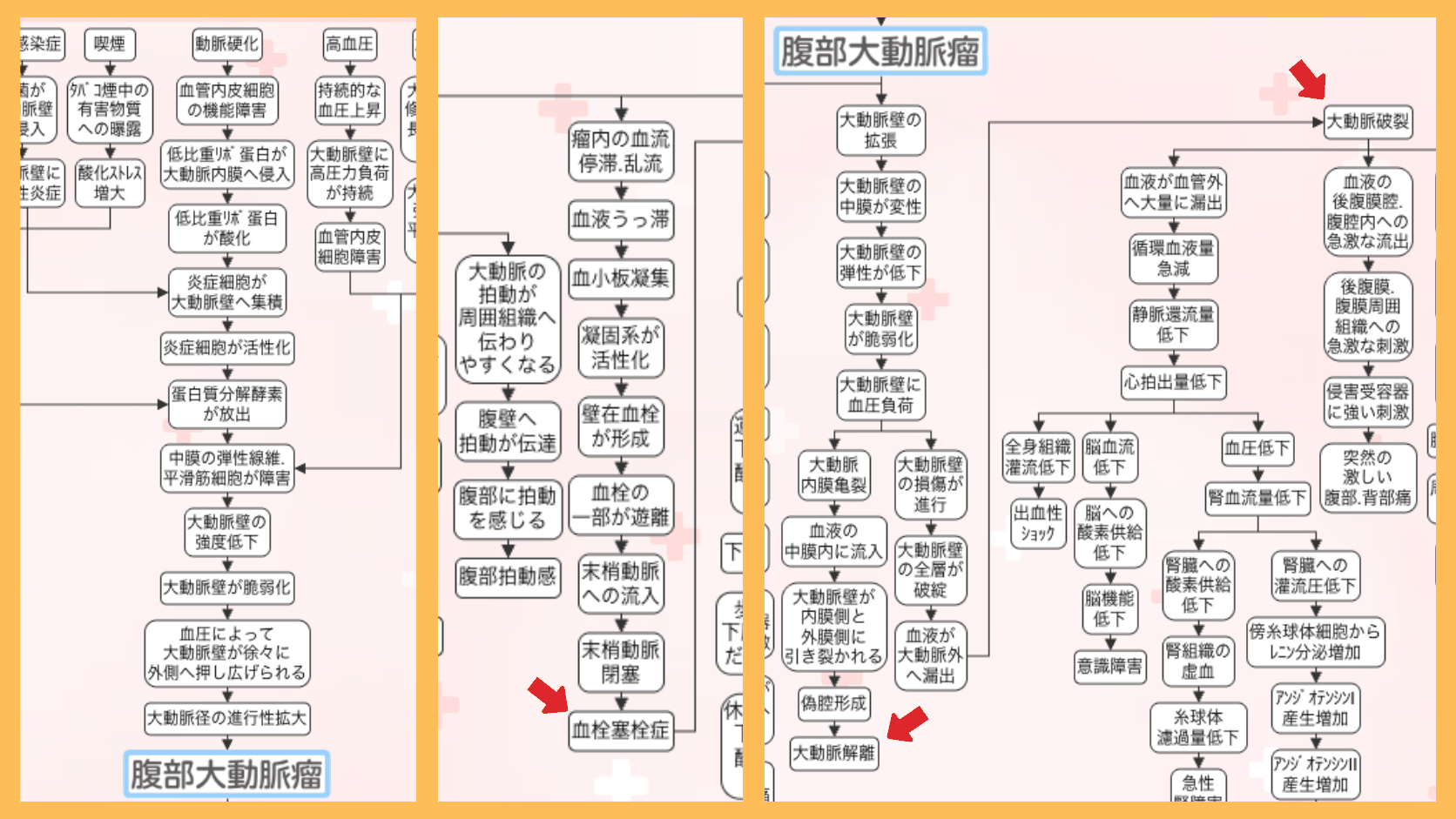 腹部大動脈瘤の合併症の関連図。壁在血栓が形成されて血栓塞栓症に至る流れ、大動脈内膜亀裂から偽腔形成を経て大動脈解離に至る流れ、大動脈壁の全層が破綻して大動脈破裂に至る流れを矢印でつないだ図