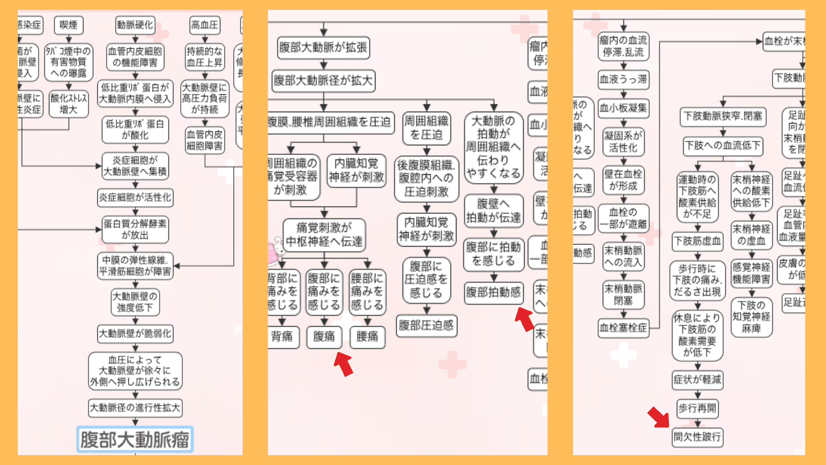腹部大動脈瘤の症状の関連図。腹部大動脈径が拡大して後腹膜・腰椎周囲組織を圧迫し腹痛に至る流れ、腹壁へ拍動が伝達されて腹部拍動感に至る流れ、瘤内の血栓が末梢へ飛んで間欠性跛行に至る流れを矢印でつないだ図