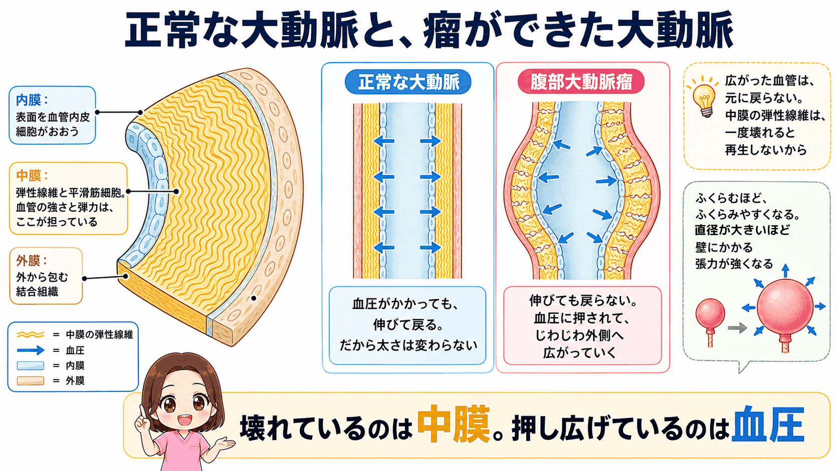 正常な大動脈と腹部大動脈瘤の大動脈を比べた図解。内膜・中膜・外膜の3層構造を示し、中膜の弾性線維がしっかりしていれば血圧がかかっても伸びて戻るが、壊れると伸びても戻らず血圧に押されて外側へ広がっていくことを示している