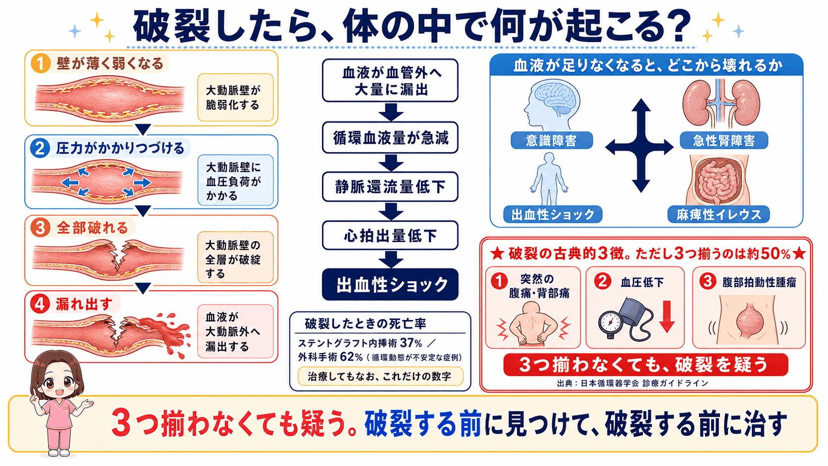 腹部大動脈瘤の破裂の図解。壁の全層が破綻して血液が漏れ出し、循環血液量が急減して出血性ショックに至る流れと、破裂の古典的3徴(突然の腹痛・背部痛、血圧低下、腹部拍動性腫瘤)が3つ揃うのは約50%であることを示している