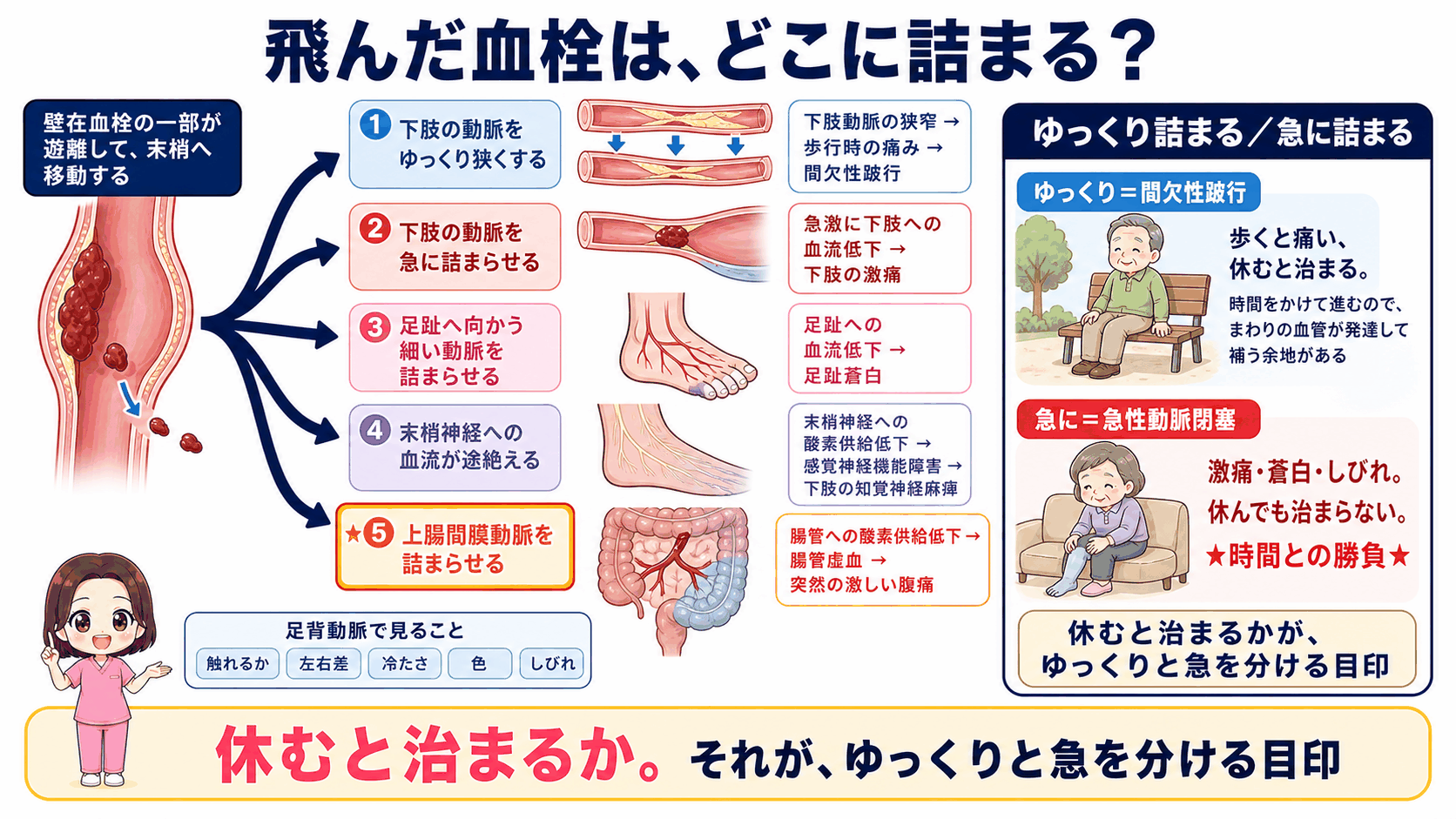腹部大動脈瘤の血栓塞栓症の図解。壁在血栓の一部が末梢へ飛んで、下肢の動脈や足趾の動脈、末梢神経、上腸間膜動脈を詰まらせる5つのルートと、ゆっくり詰まる場合と急に詰まる場合の違いを示している