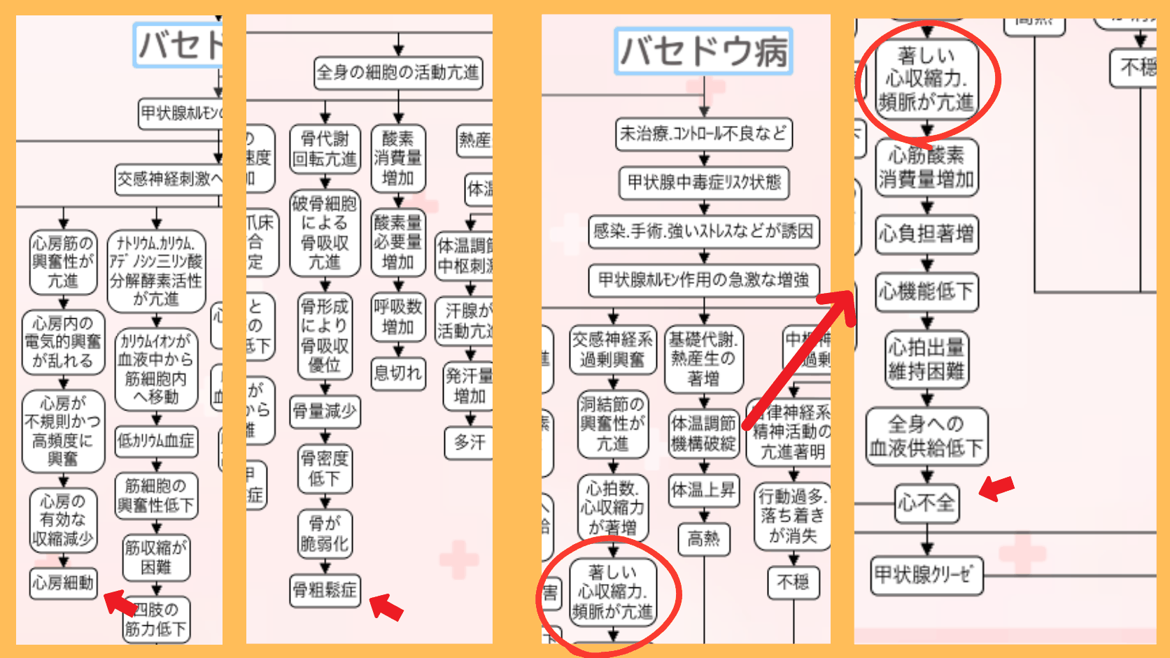 バセドウ病の関連図の全体像。赤い矢印で合併症(甲状腺クリーゼから心不全に至る流れ・心房細動・骨粗鬆症)の位置を示している