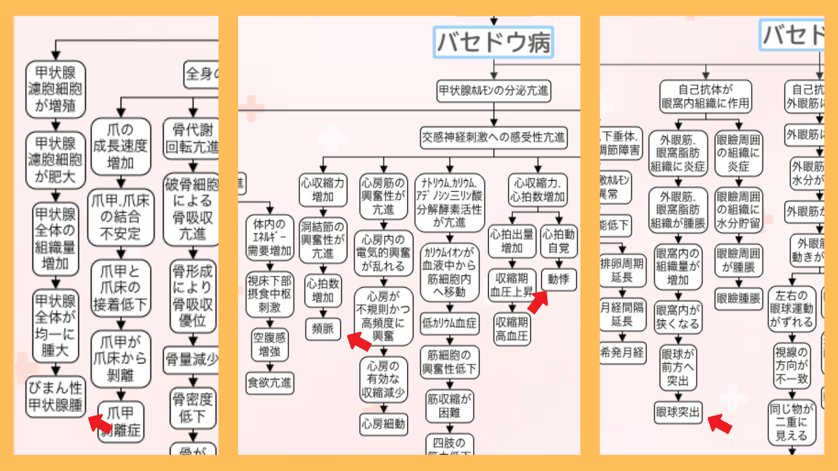 バセドウ病の関連図の全体像。赤い矢印で症状(びまん性甲状腺腫・頻脈・眼球突出=メルゼブルクの三徴)の位置を示している
