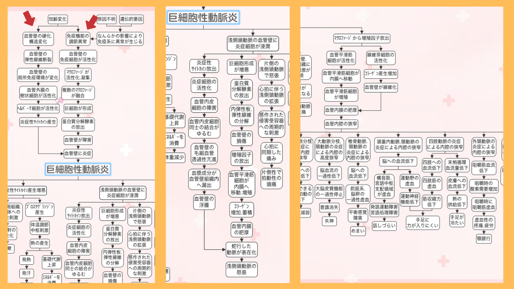巨細胞性動脈炎の関連図の全体像。赤い矢印で原因(加齢変化による血管壁の硬化・構造変化と免疫機能の調節異常)の位置を示している