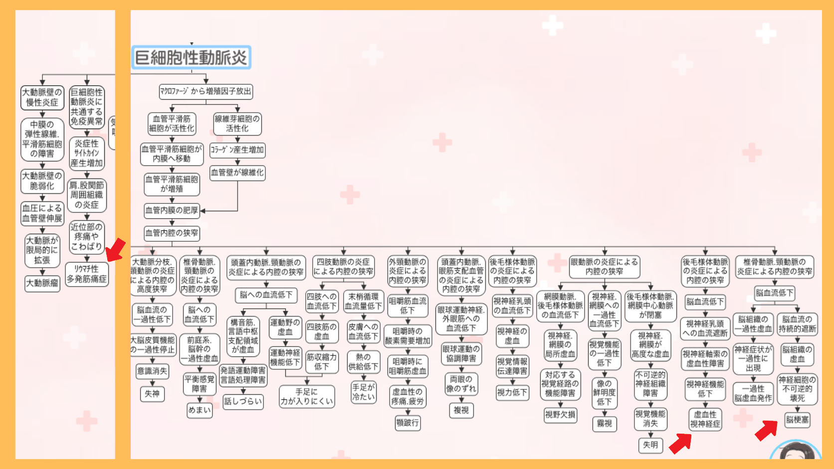 巨細胞性動脈炎の関連図の全体像。赤い矢印で合併症(リウマチ性多発筋痛症・虚血性視神経症・脳梗塞)の位置を示している