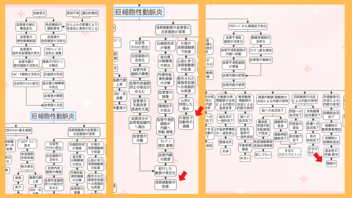 巨細胞性動脈炎の関連図の全体像。赤い矢印で症状(浅側頭動脈の怒張・拍動性の頭痛・顎跛行)の位置を示している