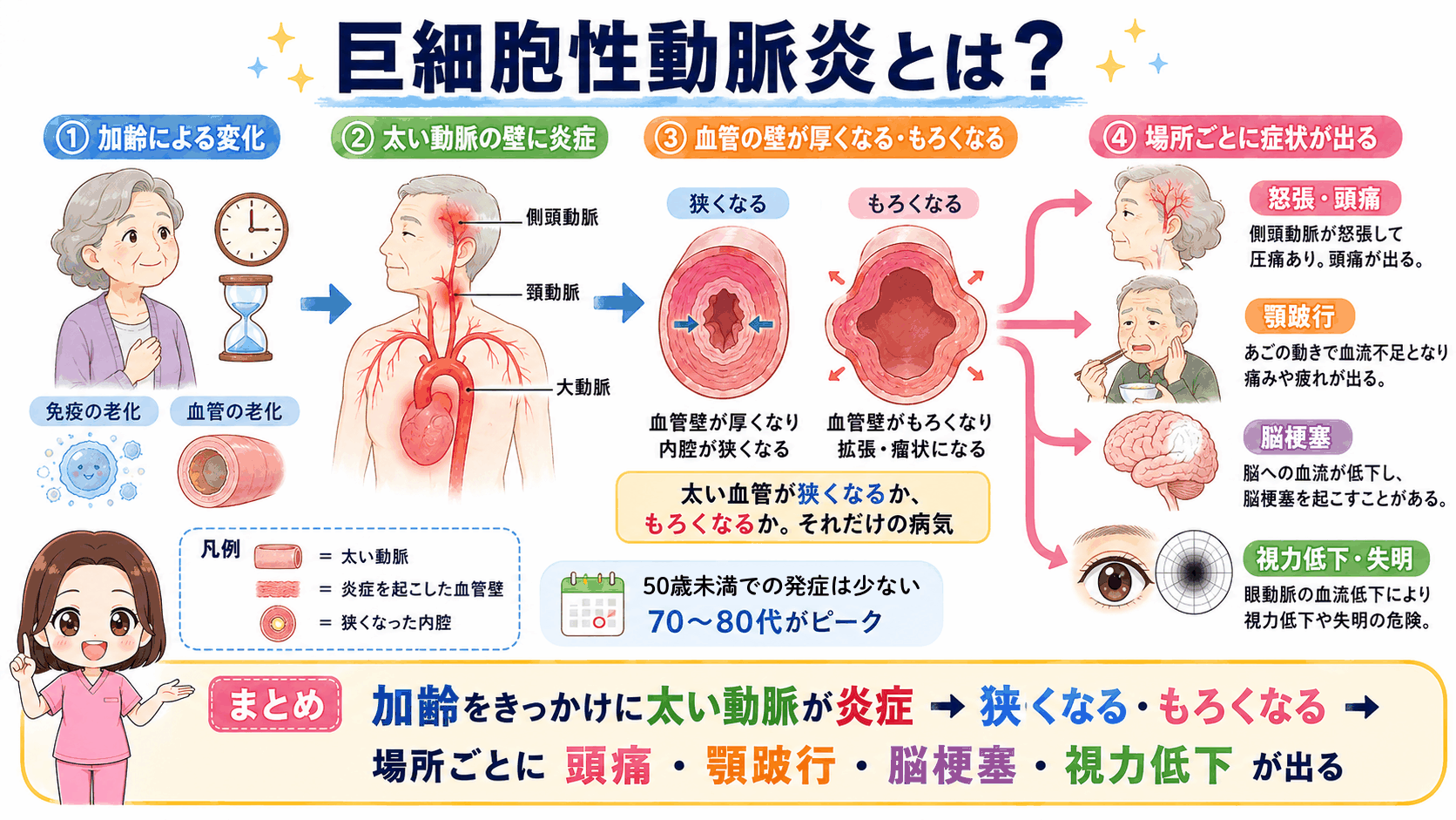 巨細胞性動脈炎とは?加齢による変化から太い動脈の炎症、血管が狭くなる・もろくなる流れを経て、怒張・頭痛・顎跛行・脳梗塞・視力低下に枝分かれする図解
