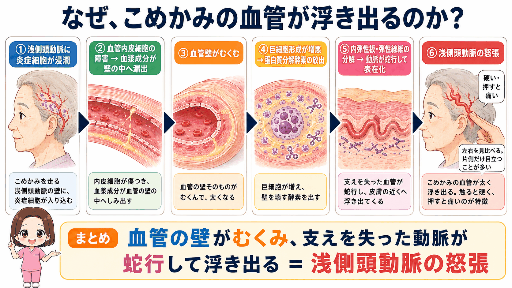 浅側頭動脈が怒張するしくみの図解。炎症細胞の浸潤から血管壁がむくみ、支えを失った動脈が蛇行して皮膚の下に浮き出るまでの6ステップ