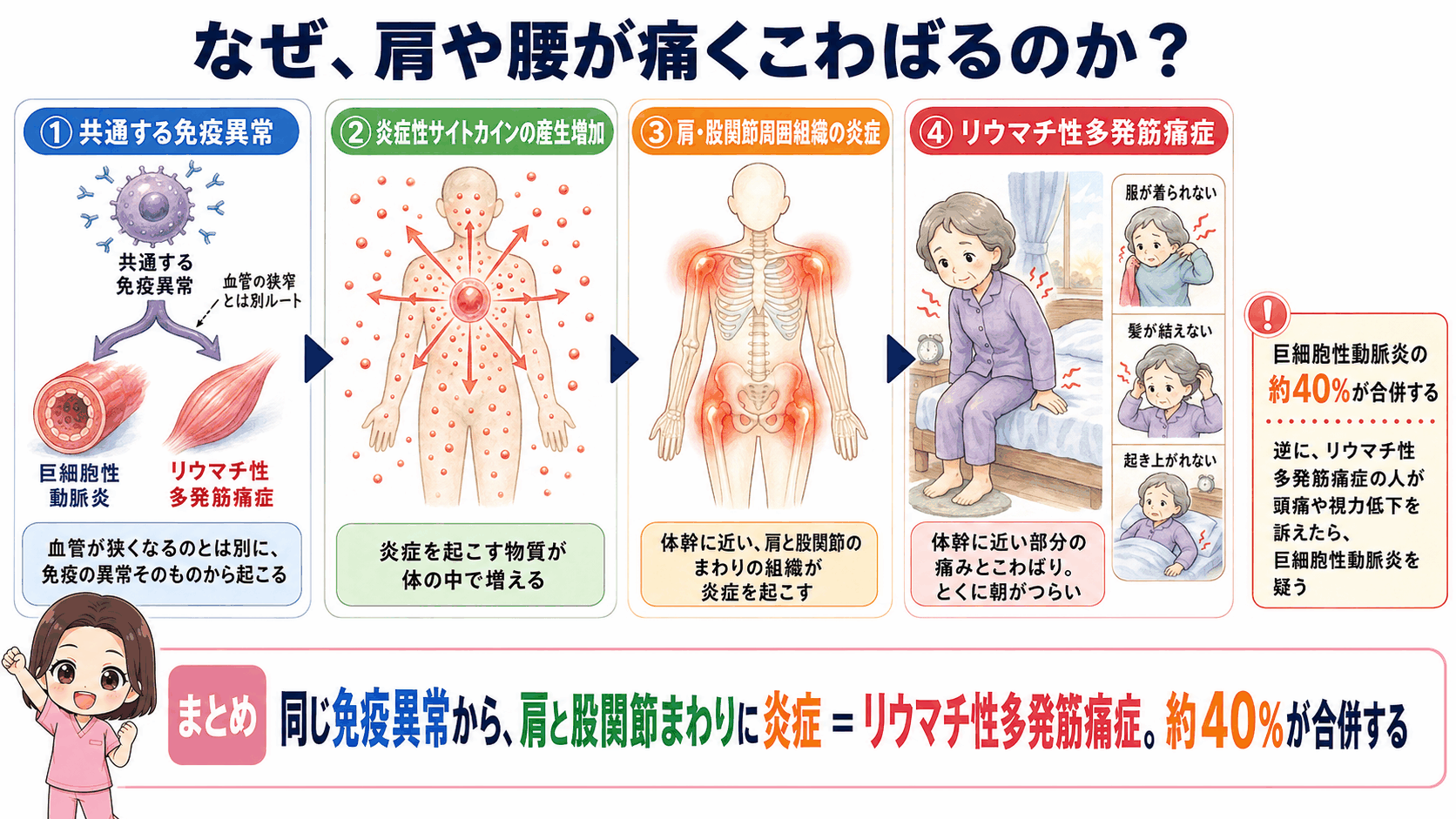 リウマチ性多発筋痛症を合併するしくみの図解。共通する免疫異常から炎症性サイトカインが増え、肩・股関節周囲の炎症で朝のこわばりが出るまでの4ステップ