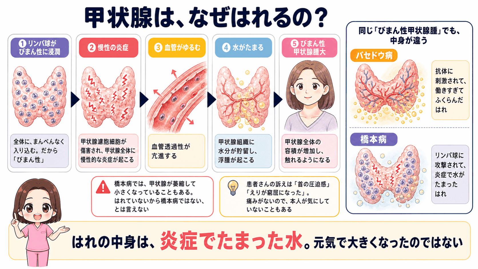 橋本病でびまん性甲状腺腫大が起こるしくみの図解。リンパ球がびまん性に浸潤して慢性の炎症が起こり、血管透過性が亢進して水がたまり甲状腺全体の容積が増加する流れと、バセドウ病の甲状腺腫との違いを示している