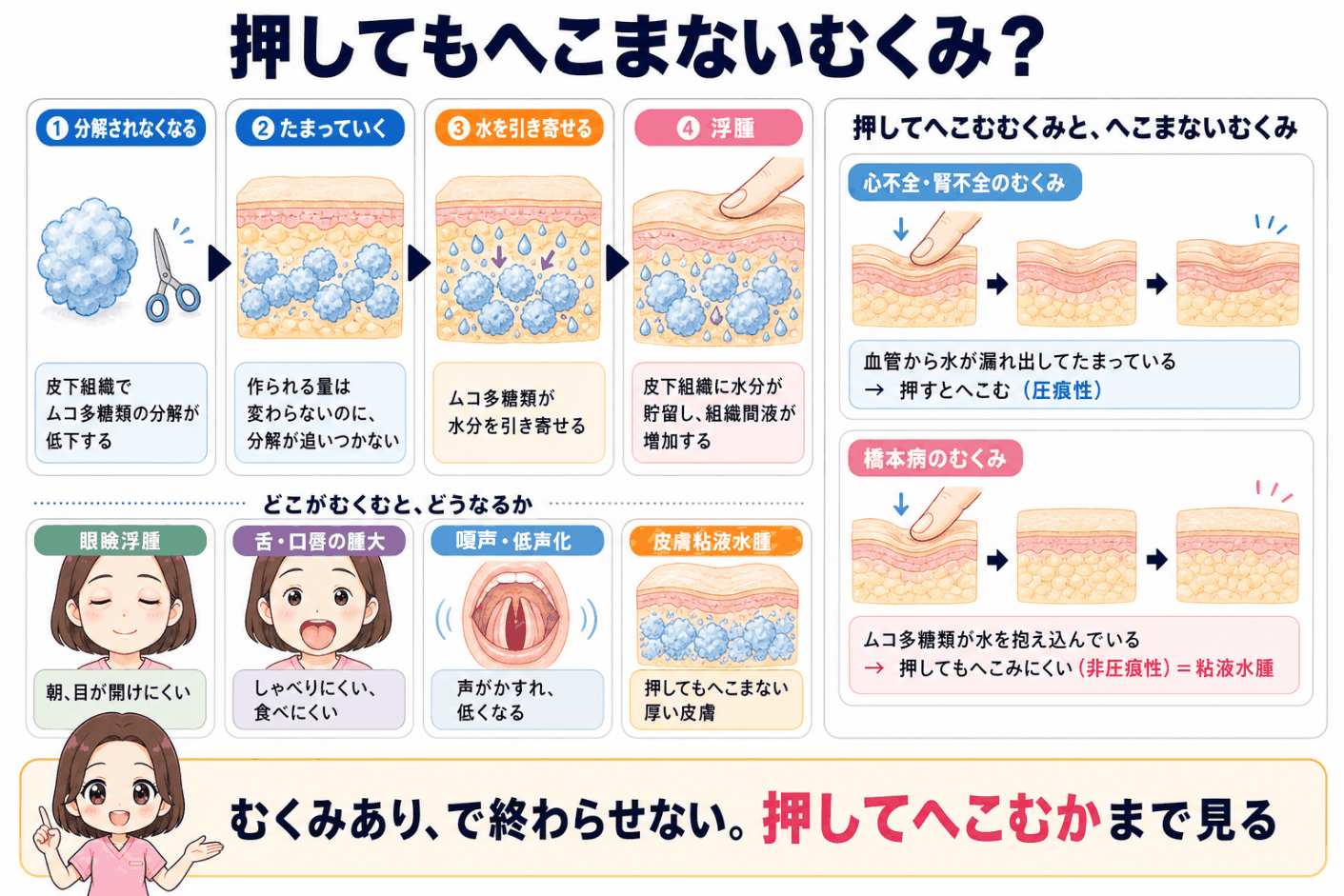 橋本病の浮腫のしくみの図解。皮下組織でムコ多糖類の分解が低下して蓄積し、水分を引き寄せて浮腫が起こる流れと、押してへこむ圧痕性浮腫との違い、まぶた・舌口唇・声帯・皮膚に出る症状を示している