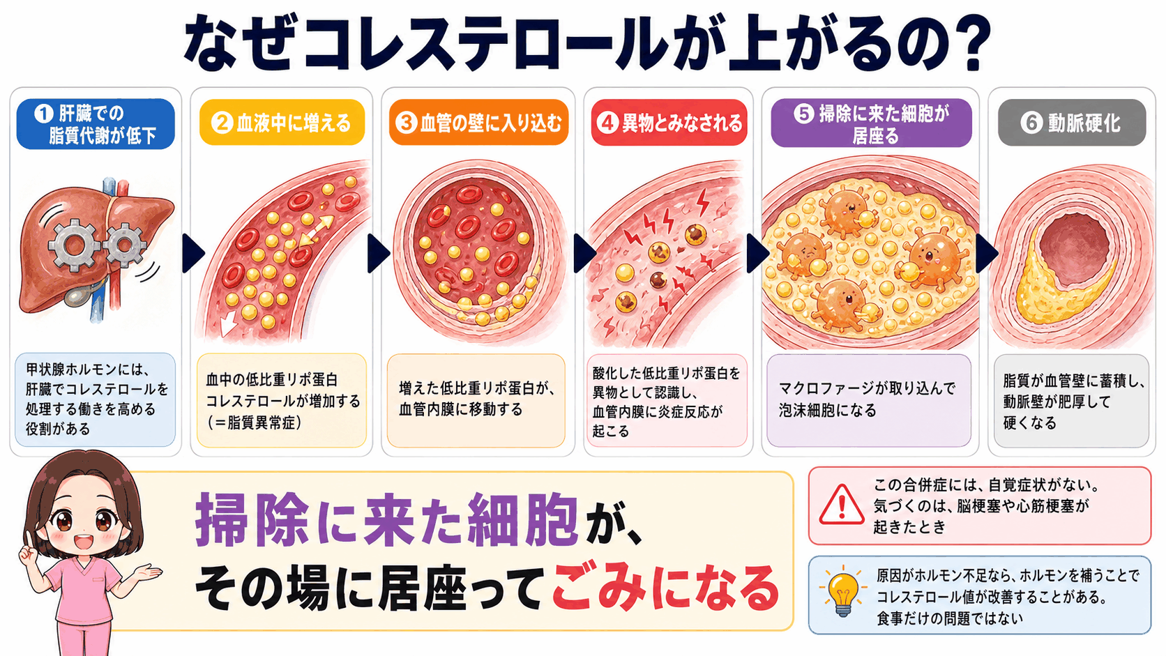 橋本病で動脈硬化が起こるしくみの図解。肝臓での脂質代謝が低下して低比重リポ蛋白コレステロールが増え、血管内膜に入り込んで炎症が起こり、マクロファージが泡沫細胞になって脂質が蓄積し動脈壁が硬くなる流れを示している