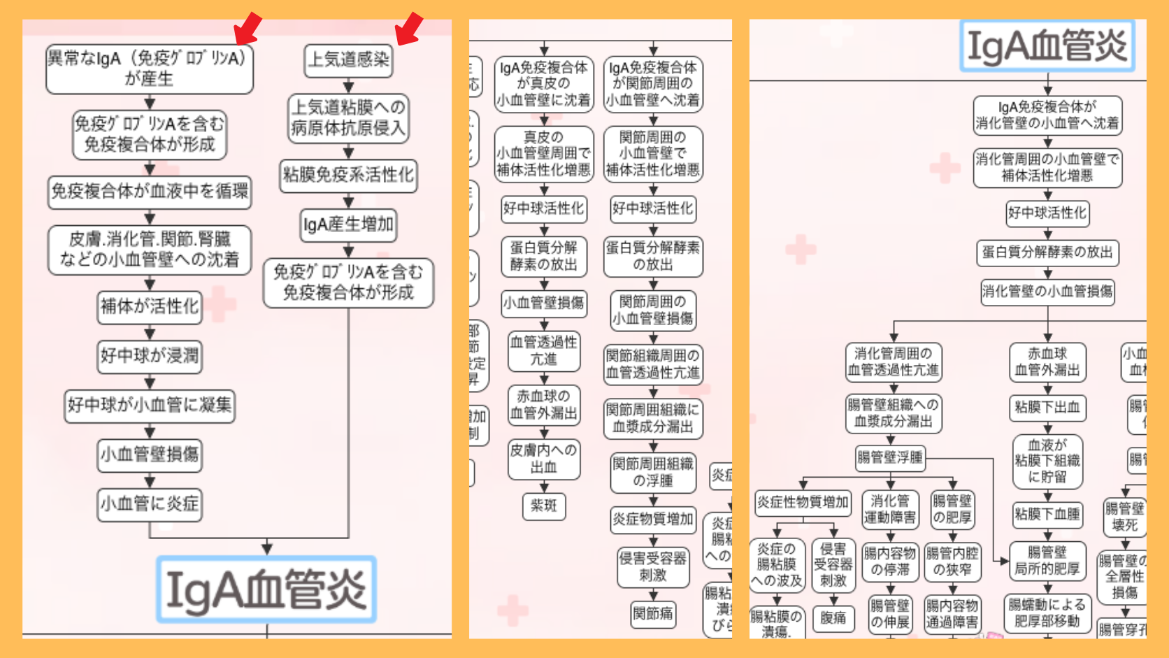 IgA血管炎の関連図の全体像。赤い矢印で原因(異常なIgAの産生・上気道感染)の位置を示している