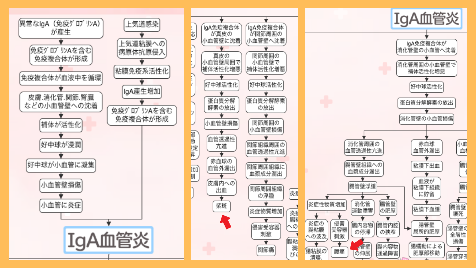 IgA血管炎の関連図の全体像。赤い矢印で症状(紫斑・腹痛)の位置を示している