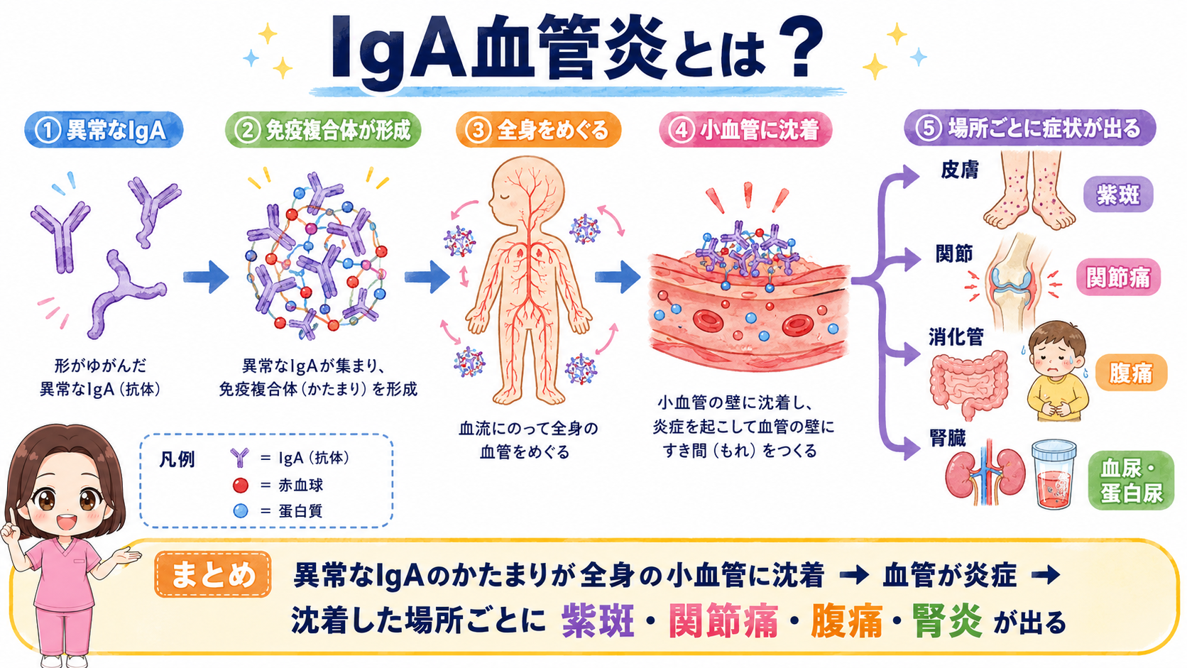 IgA血管炎とは?異常なIgAの免疫複合体が全身の小血管に沈着し、皮膚の紫斑・関節痛・腹痛・腎炎に枝分かれする流れの図解