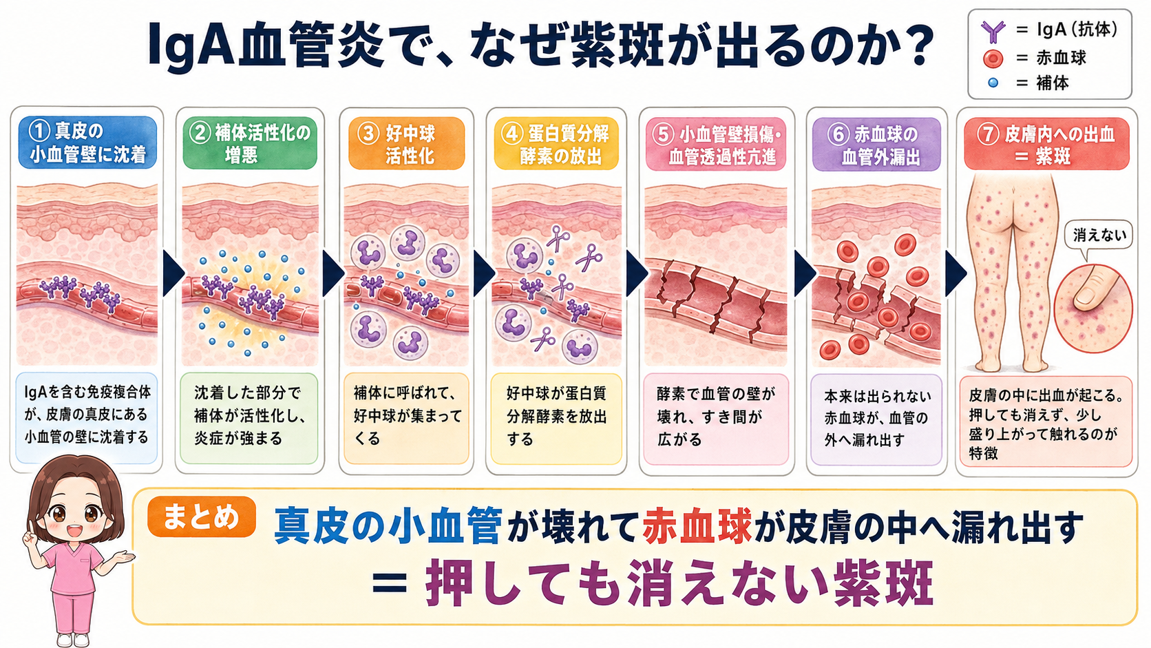 IgA血管炎で紫斑が出るしくみの図解。真皮の小血管への沈着から血管透過性亢進、赤血球の血管外漏出を経て押しても消えない紫斑に至る7ステップ