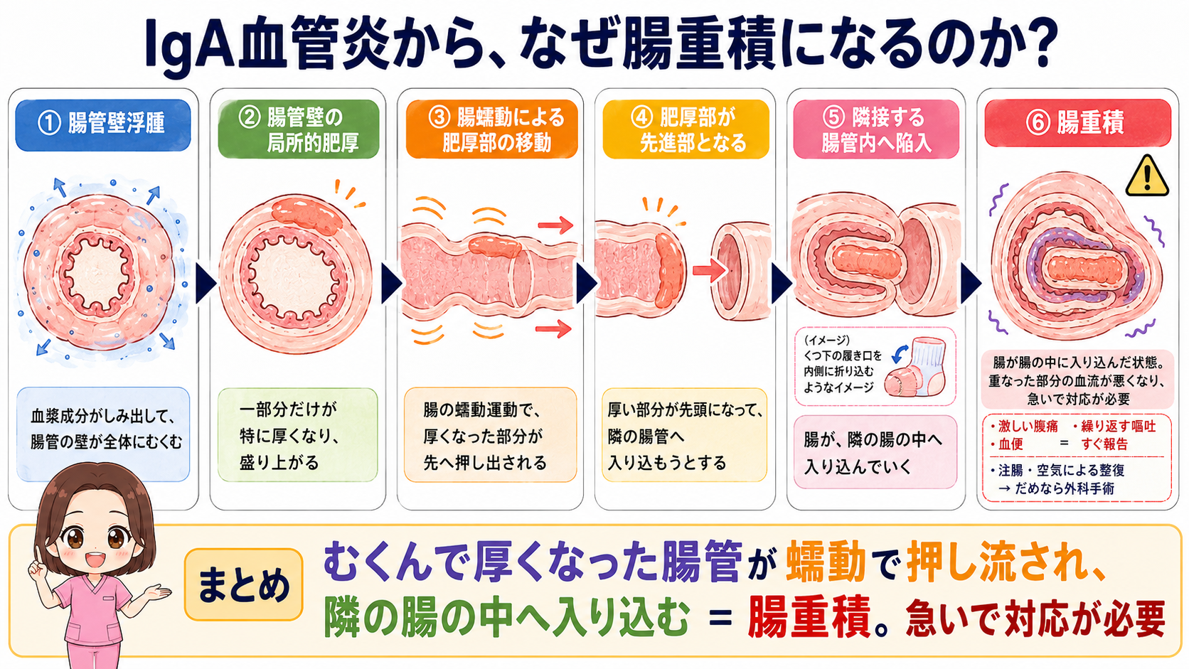 IgA血管炎から腸重積になるしくみの図解。腸管壁浮腫から局所的な肥厚、蠕動による移動を経て腸管が腸管内へ陥入するまでの6ステップ
