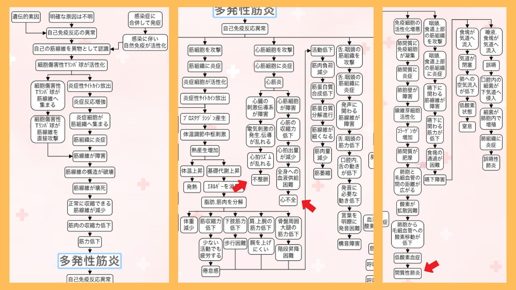多発性筋炎の合併症の関連図。心筋炎から不整脈と心不全に分かれる流れと、肺間質に免疫細胞が凝集して間質性肺炎に至る流れを矢印でつないだ図