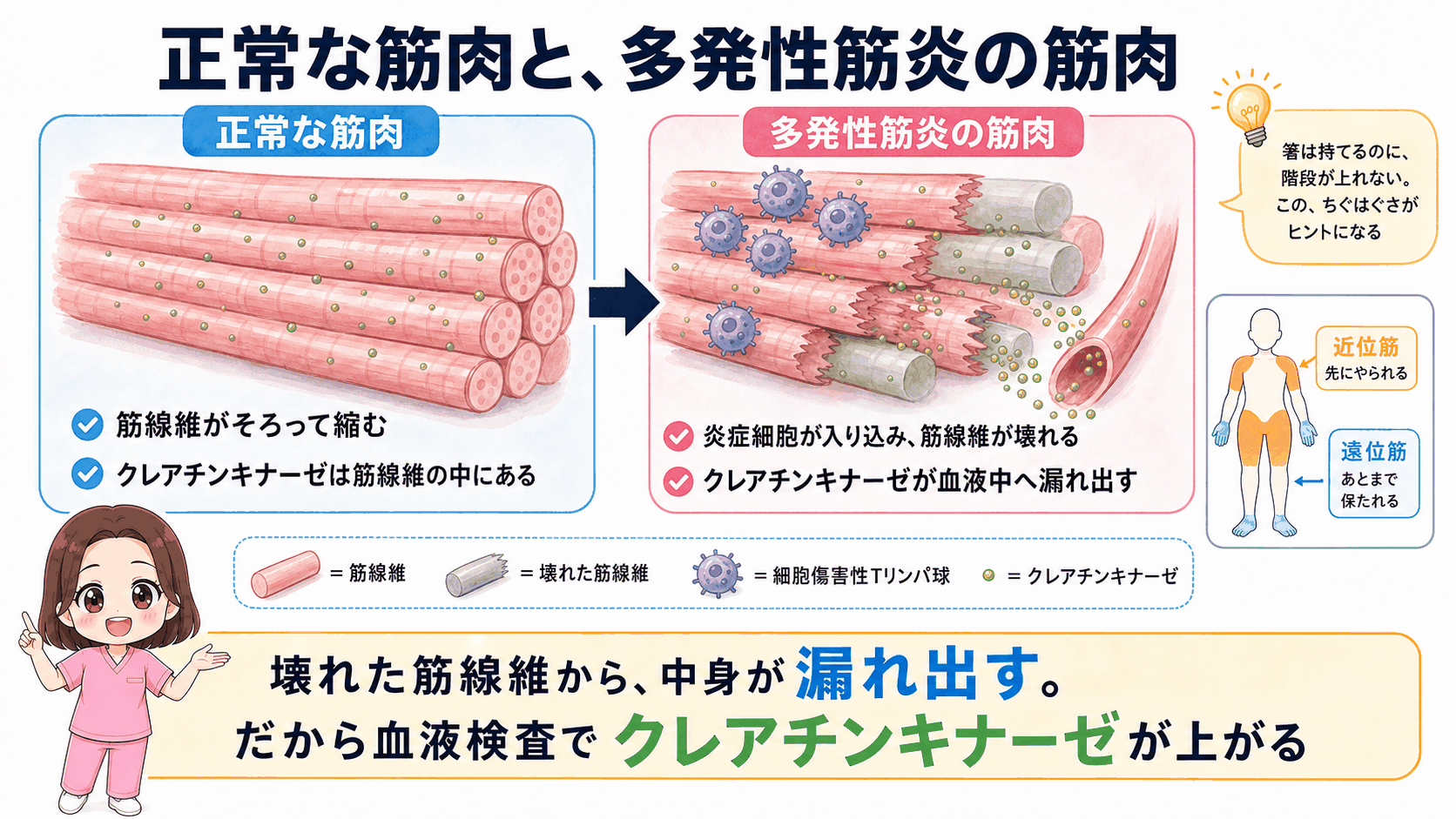 正常な筋肉と多発性筋炎の筋肉を比べた図解。筋線維がそろって縮む正常な状態と、炎症細胞が入り込んで筋線維が壊れクレアチンキナーゼが血液中へ漏れ出す状態を並べ、近位筋と遠位筋の違いもあわせて示している