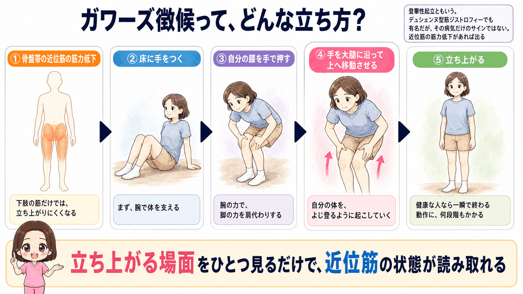 ガワーズ徴候(登攀性起立)の図解。骨盤帯の近位筋の筋力低下により、床に手をつき、自分の膝を手で押し、手を大腿に沿って上へ移動させて立ち上がるという4つの動きを順に示している