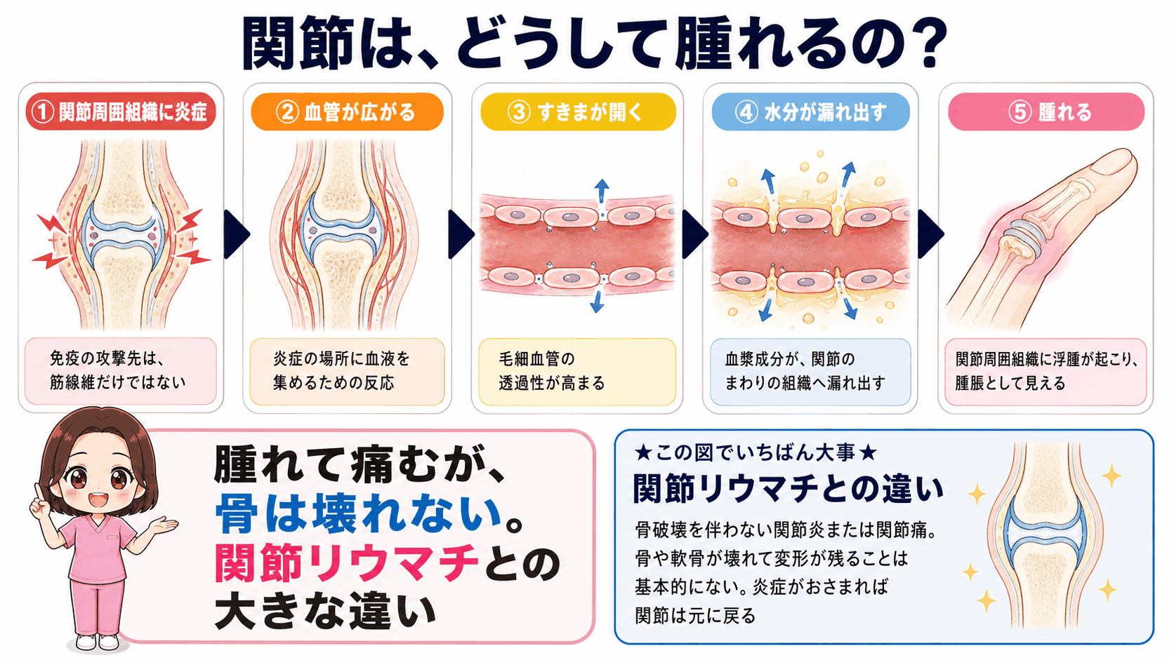 多発性筋炎の関節炎のしくみの図解。関節周囲組織の炎症から血管が広がり、毛細血管の透過性が高まって水分が漏れ出し腫脹に至る流れと、骨破壊を伴わない点で関節リウマチと違うことを示している