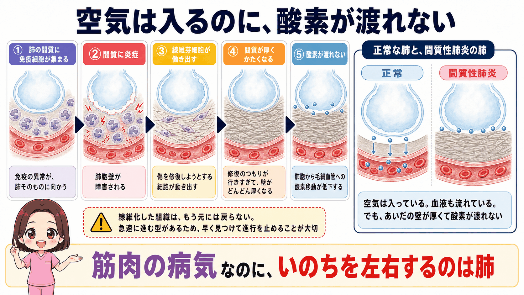 多発性筋炎の間質性肺炎のしくみの図解。肺の間質に免疫細胞が集まり炎症が起こって線維化し、間質が厚くなって肺胞から毛細血管への酸素移動が低下する流れを、正常な肺との比較とあわせて示している