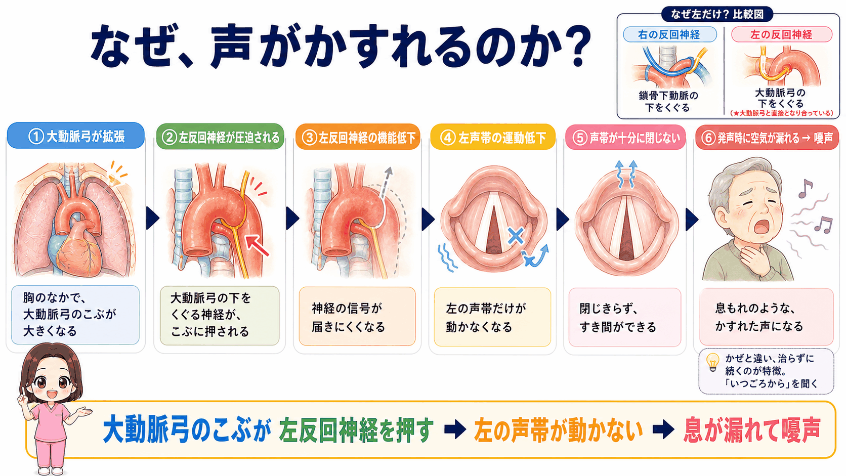 胸部大動脈瘤で声がかすれるしくみの図解。大動脈弓の拡張が左反回神経を圧迫し、左の声帯が動かなくなって嗄声に至る6ステップ