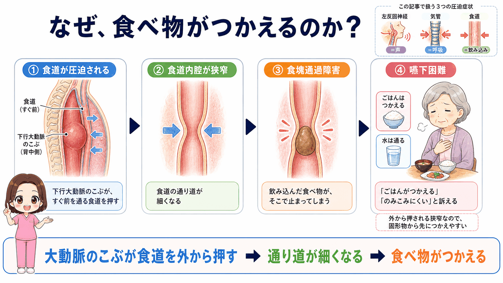 胸部大動脈瘤で食べ物がつかえるしくみの図解。下行大動脈のこぶが食道を押して内腔が狭くなり、嚥下困難に至る4ステップ