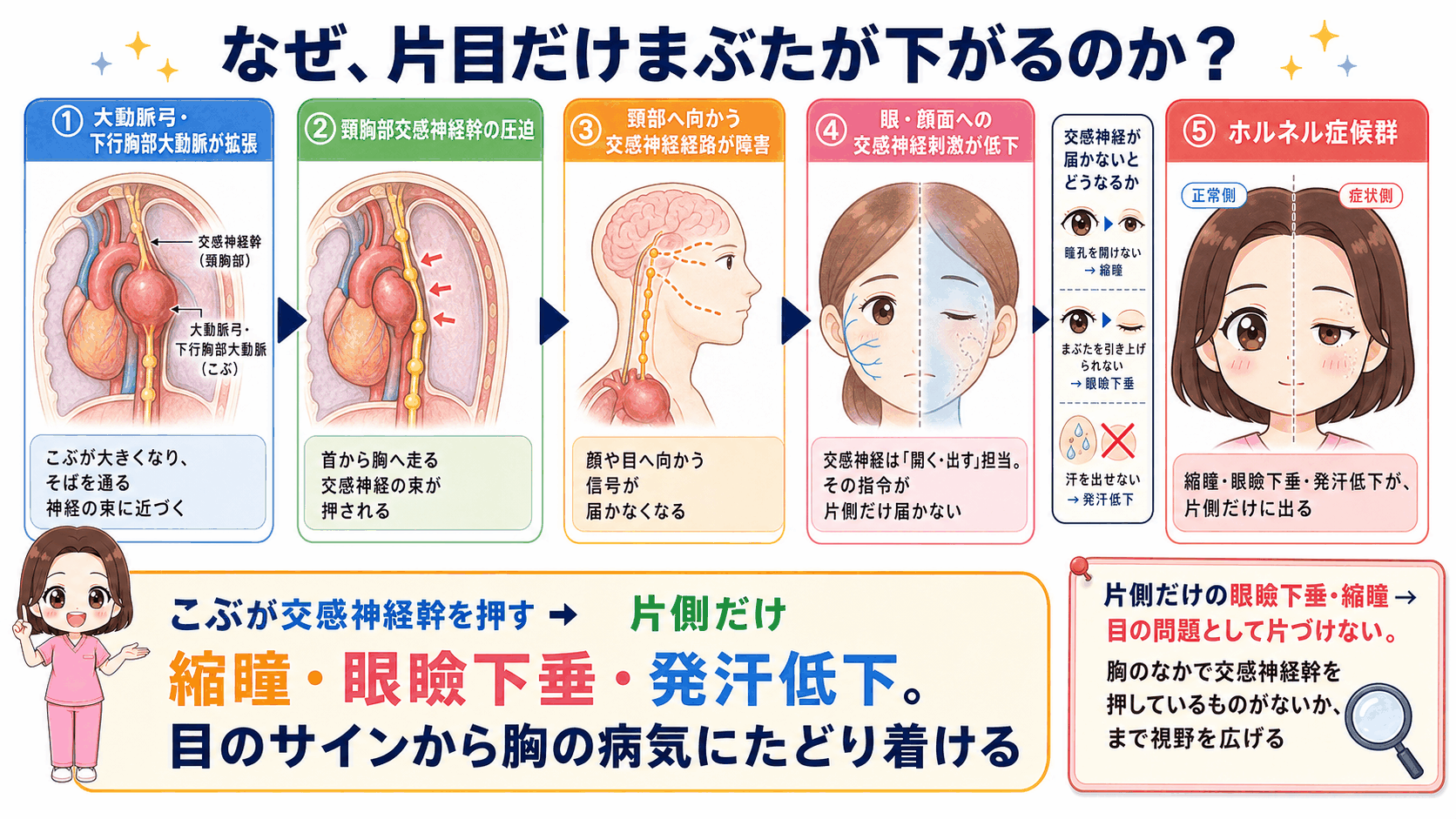 胸部大動脈瘤でホルネル症候群が起こるしくみの図解。頸胸部交感神経幹の圧迫により、片側だけに縮瞳・眼瞼下垂・発汗低下が出る流れ