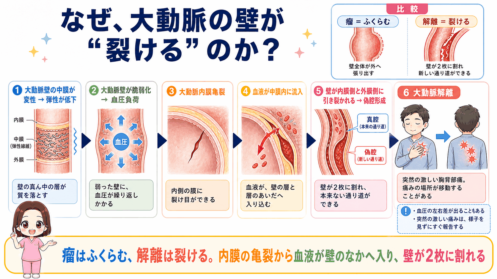 大動脈解離が起こるしくみの図解。内膜の亀裂から血液が中膜へ流入し、壁が2枚に引き裂かれて偽腔ができるまでの6ステップ。瘤との比較つき